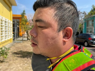 消毒人員賴韋宏因長時間戴口罩,產生口罩勒痕